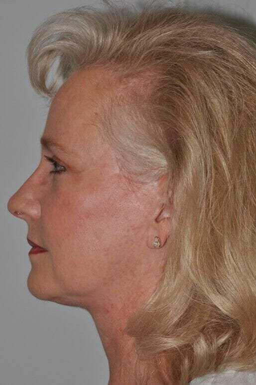 Facelift Before & After Patient #5424
