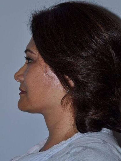 Facelift Before & After Patient #5438