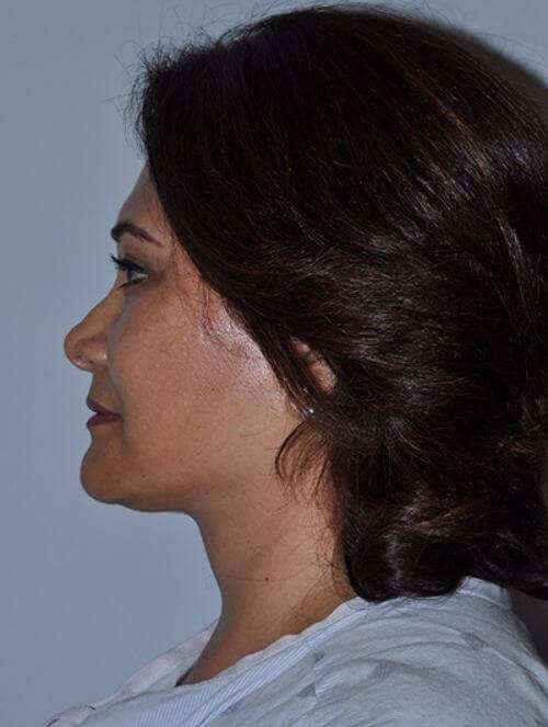 Facelift Before & After Patient #5438