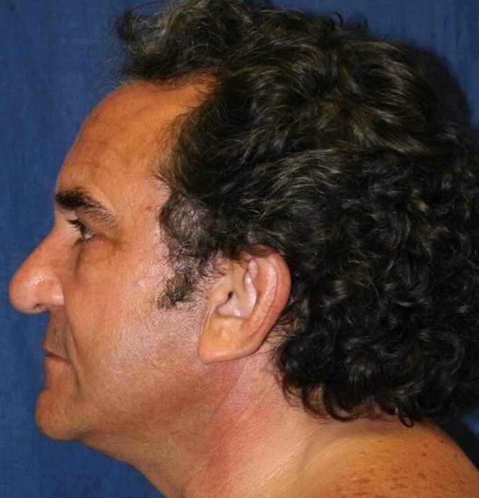 Facelift Before & After Patient #5452