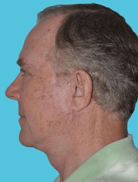Facelift Before & After Patient #5459