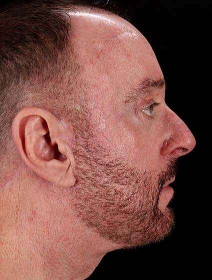 Facelift Before & After Patient #5477