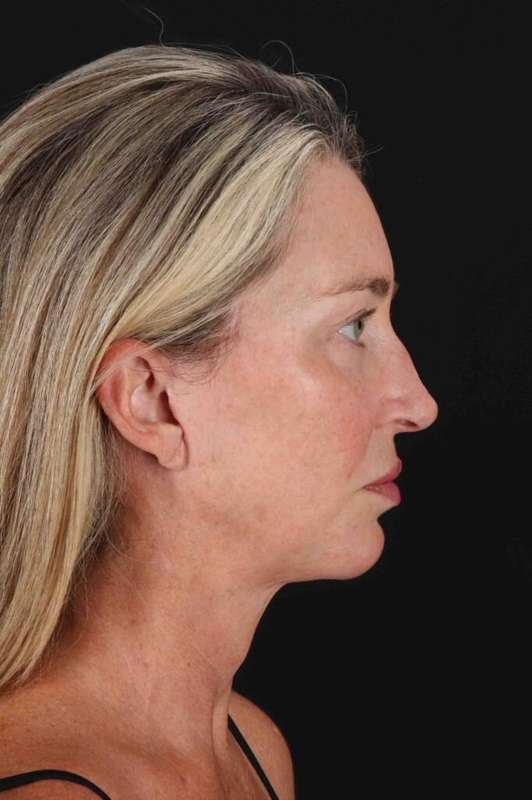 Facelift Before & After Patient #5488