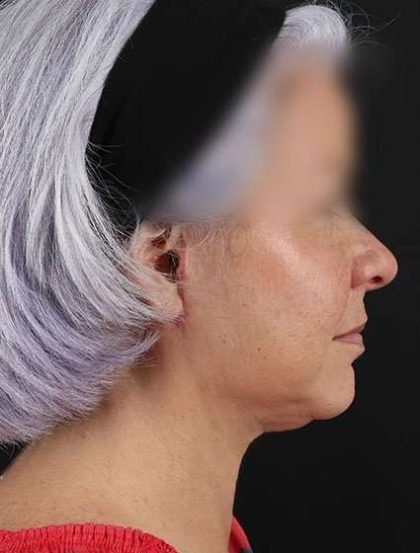 Facelift Before & After Patient #5499