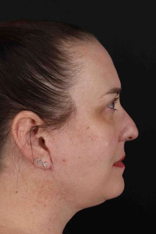 Facelift Before & After Patient #5521