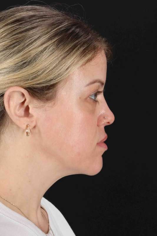 Chemical Peels Before & After Patient #5601