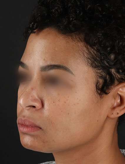 Chemical Peels Before & After Patient #5610