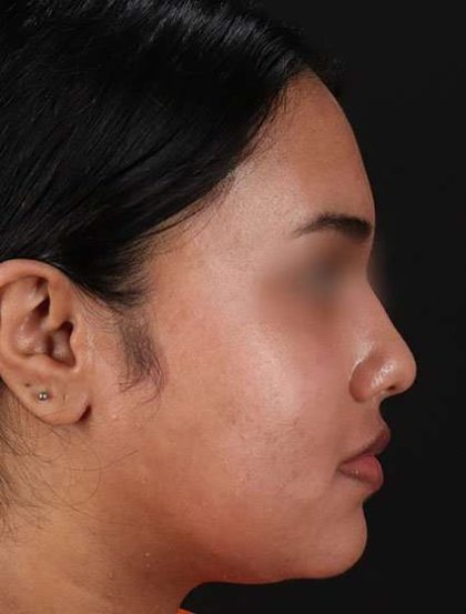 Chemical Peels Before & After Patient #5621