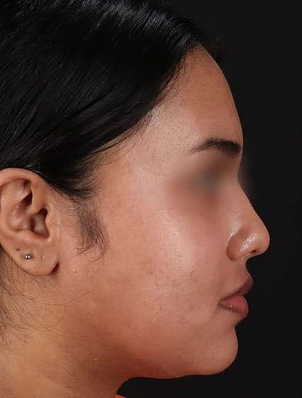 Chemical Peels Before & After Patient #5621