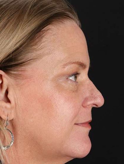 Chemical Peels Before & After Patient #5632