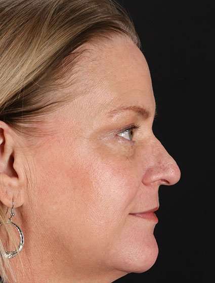Chemical Peels Before & After Patient #5632