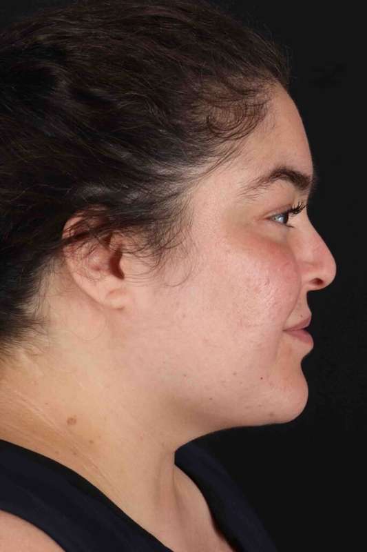 Neck Liposuction Before & After Patient #5643
