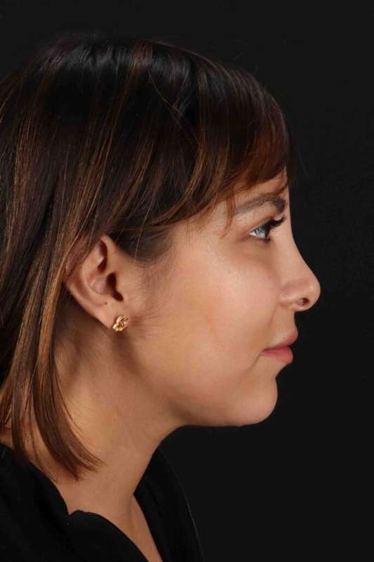 Neck Liposuction Before & After Patient #5654
