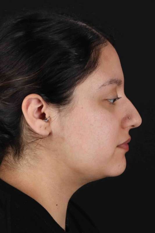 Neck Liposuction Before & After Patient #5665