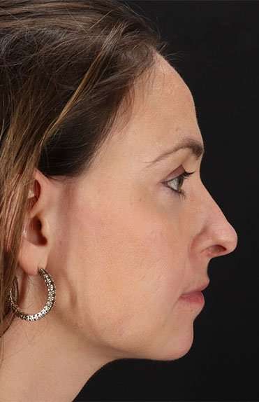 Neck Liposuction Before & After Patient #5687