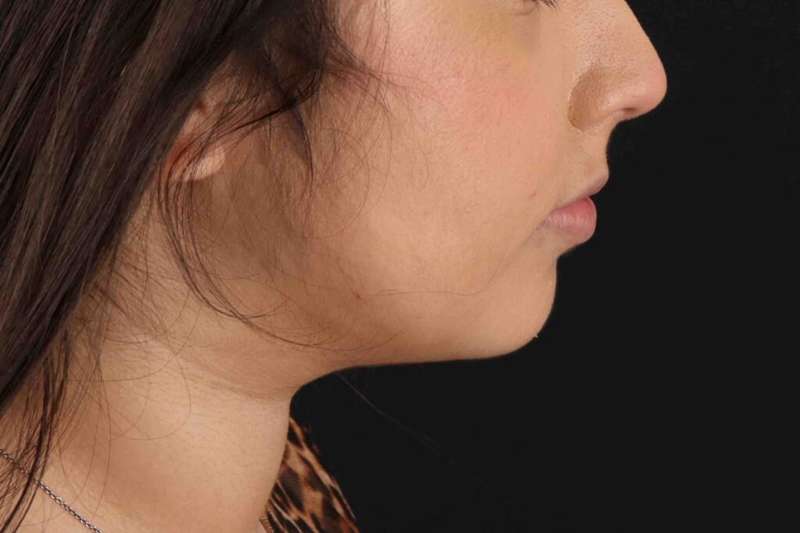 Neck Liposuction Before & After Patient #5698
