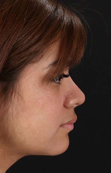 Neck Liposuction Before & After Patient #5709
