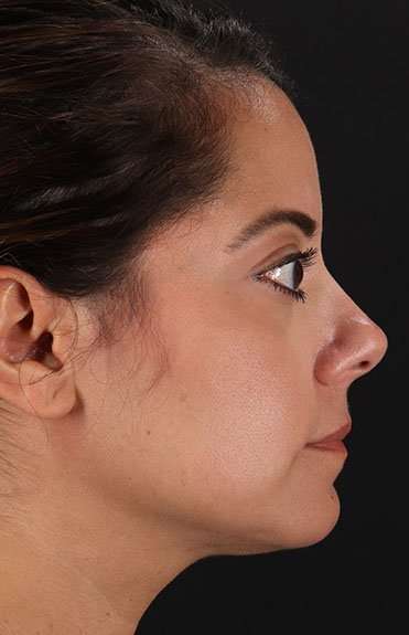 Neck Liposuction Before & After Patient #5720