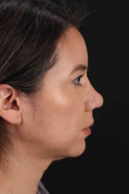 Neck Liposuction Before & After Patient #5731