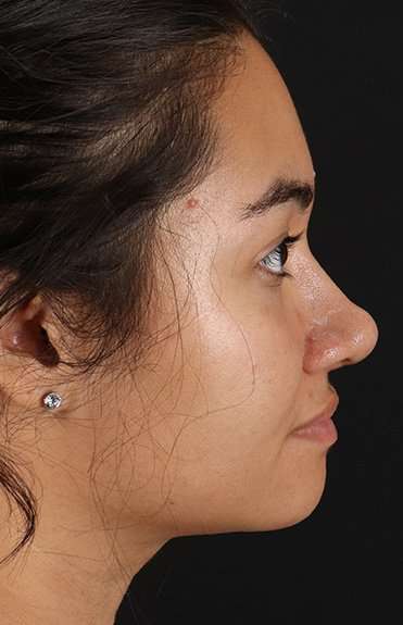 Neck Liposuction Before & After Patient #5742
