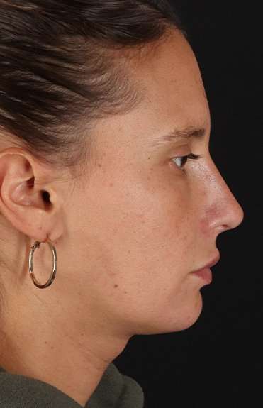 Neck Liposuction Before & After Patient #5753
