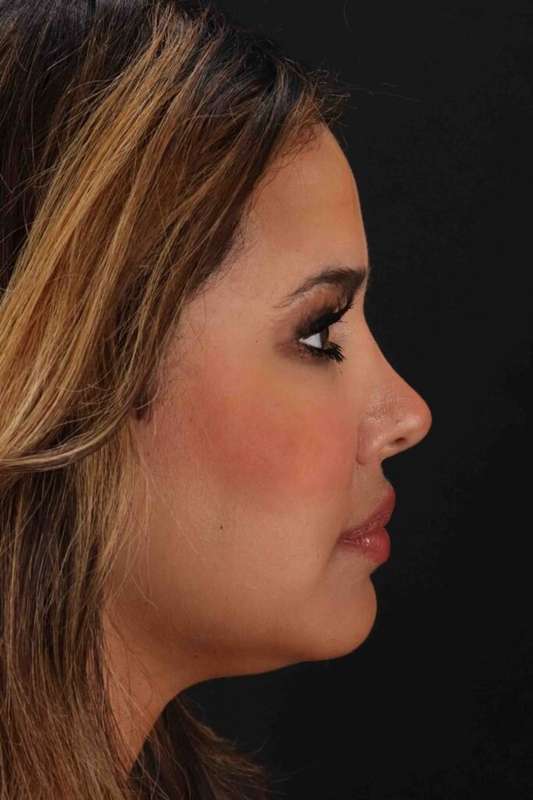 Neck Liposuction Before & After Patient #5762
