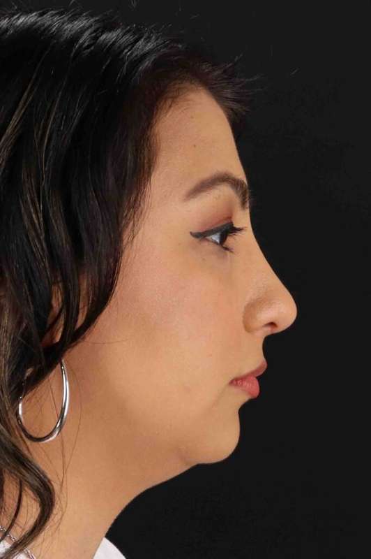 Rhinoplasty Before & After Patient #5826