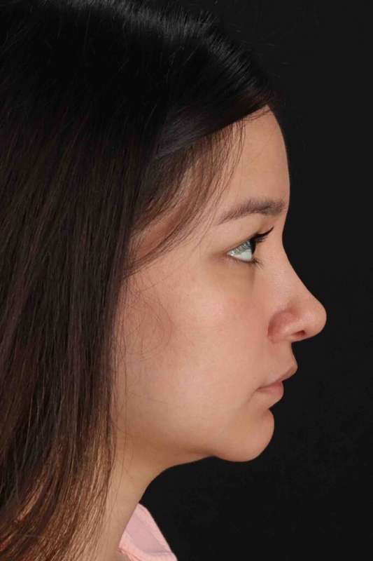 Rhinoplasty Before & After Patient #5837