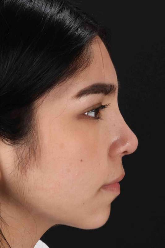Rhinoplasty Before & After Patient #5848