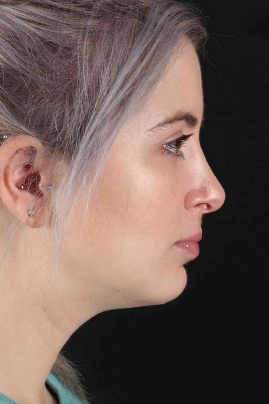 Rhinoplasty Before & After Patient #5859