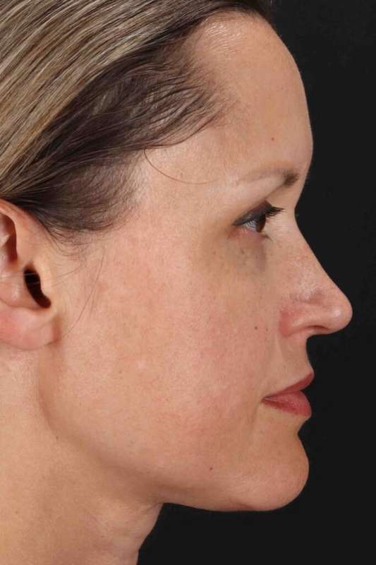 Rhinoplasty Before & After Patient #5870