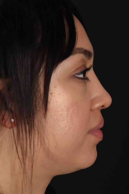 Rhinoplasty Before & After Patient #5881
