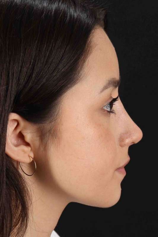 Rhinoplasty Before & After Patient #5892