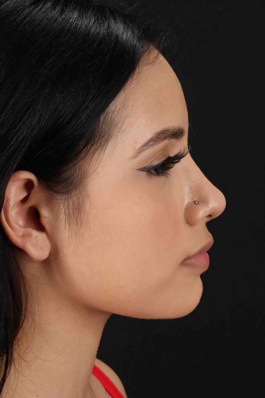 Rhinoplasty Before & After Patient #5903