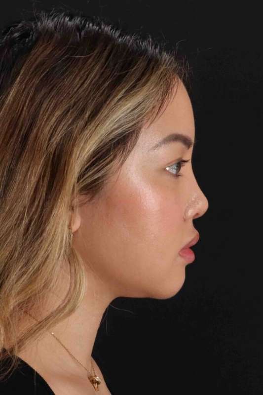 Rhinoplasty Before & After Patient #5914
