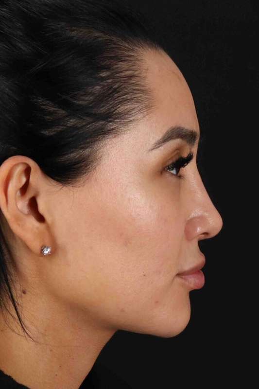 Rhinoplasty Before & After Patient #5925