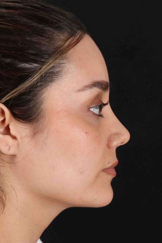 Rhinoplasty Before & After Patient #5947