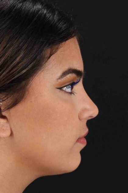 Rhinoplasty Before & After Patient #5958