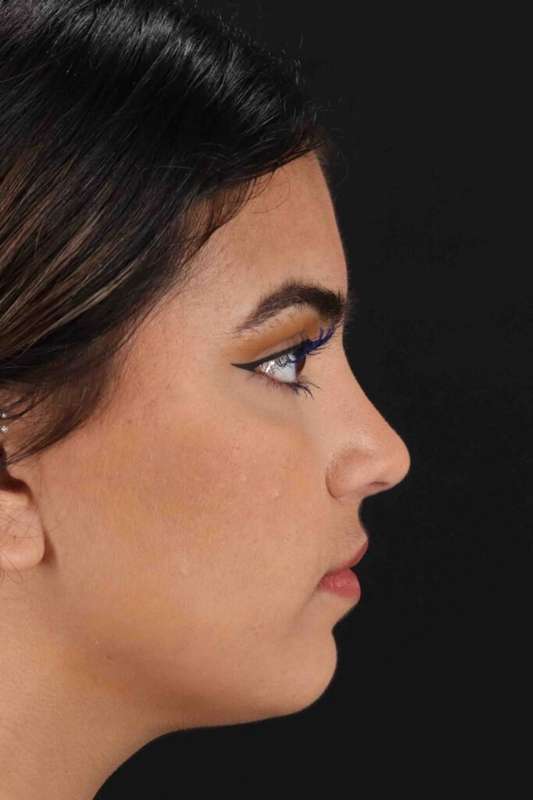 Rhinoplasty Before & After Patient #5958