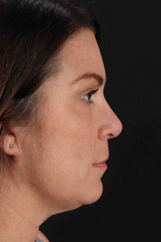 Rhinoplasty Before & After Patient #5969