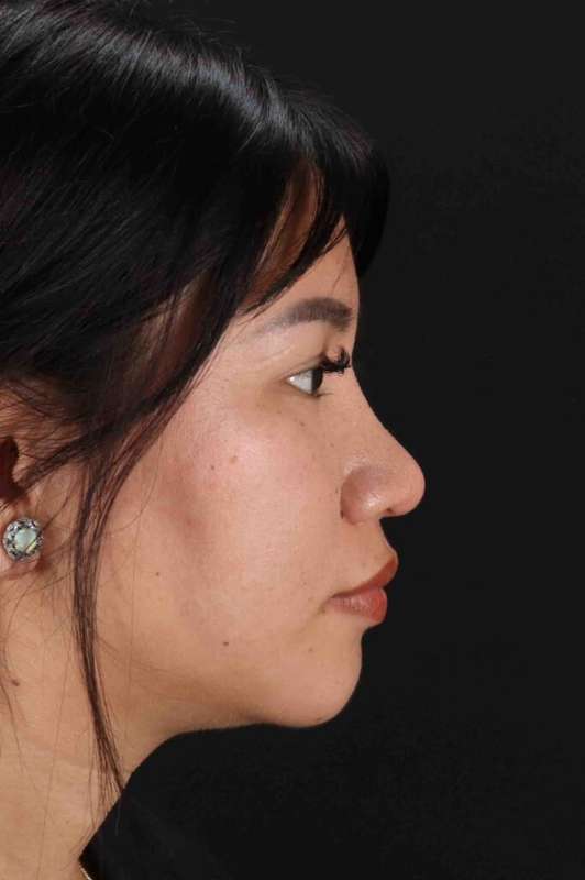 Rhinoplasty Before & After Patient #5983