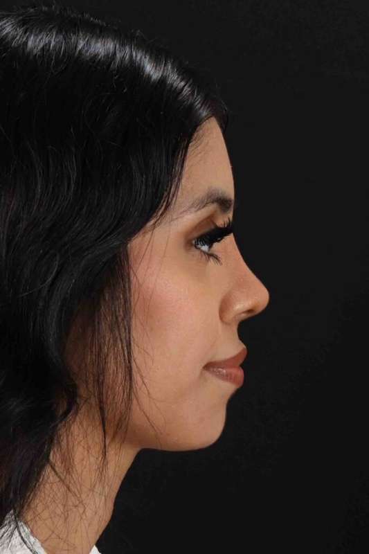 Rhinoplasty Before & After Patient #5994