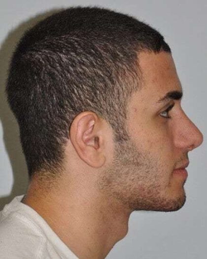Rhinoplasty Before & After Patient #6028