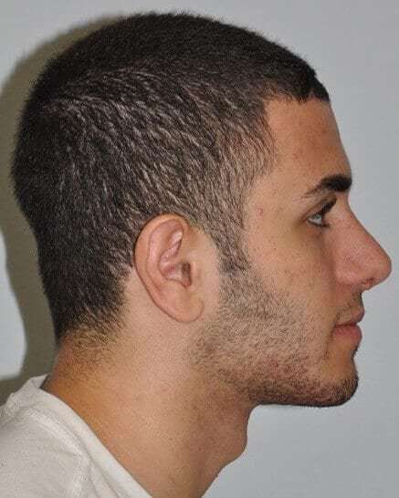 Rhinoplasty Before & After Patient #6028