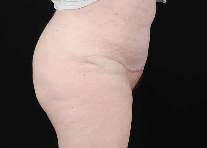 Monsplasty Before & After Patient #1117