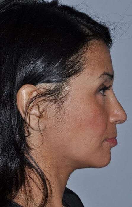 Rhinoplasty Before & After Patient #6035