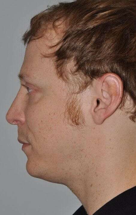 Rhinoplasty Before & After Patient #6047