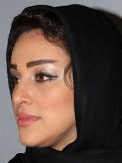 Rhinoplasty Before & After Patient #6054