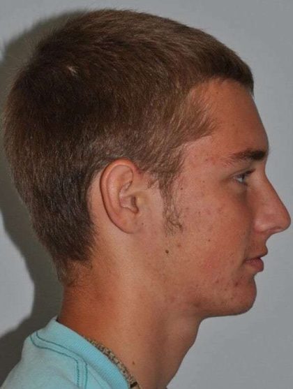 Rhinoplasty Before & After Patient #6061