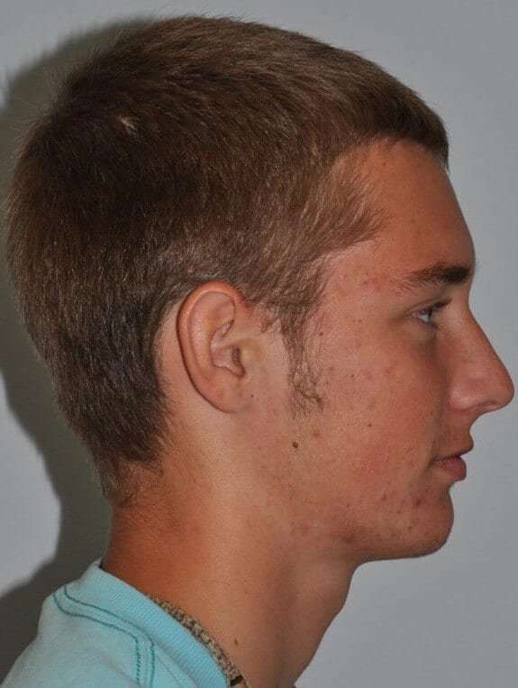 Rhinoplasty Before & After Patient #6061